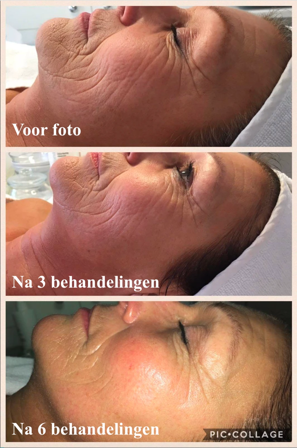 Vibra-B Face treatment